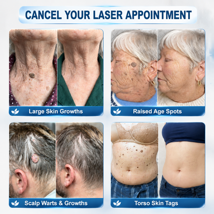 LUMIVO™👩‍⚕️ 𝟕-𝐃𝒂𝘆 𝐒𝗸𝐢𝐧 𝐓𝒂𝗴 & 𝐒𝐩𝙤𝐭 𝐄𝐫𝒂𝐬𝙚𝐫 Painless & Scar-Free Advanced Imperfection Removal Rollerball Pen