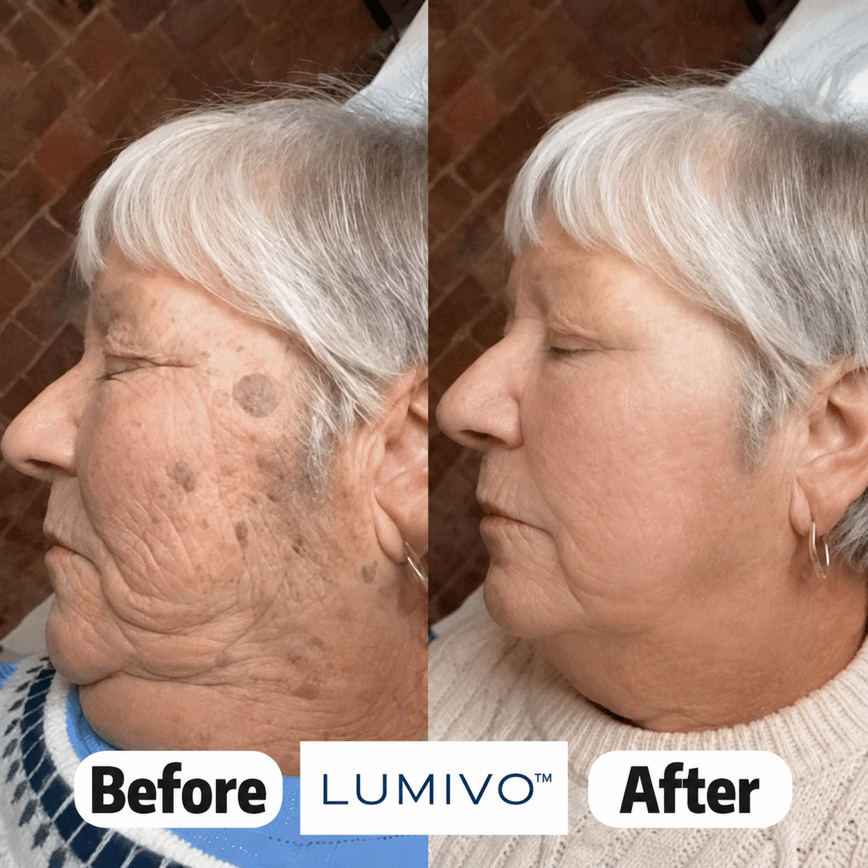 LUMIVO™👩‍⚕️ 𝟕-𝐃𝒂𝘆 𝐒𝗸𝐢𝐧 𝐓𝒂𝗴 & 𝐒𝐩𝙤𝐭 𝐄𝐫𝒂𝐬𝙚𝐫 Painless & Scar-Free Advanced Imperfection Removal Rollerball Pen