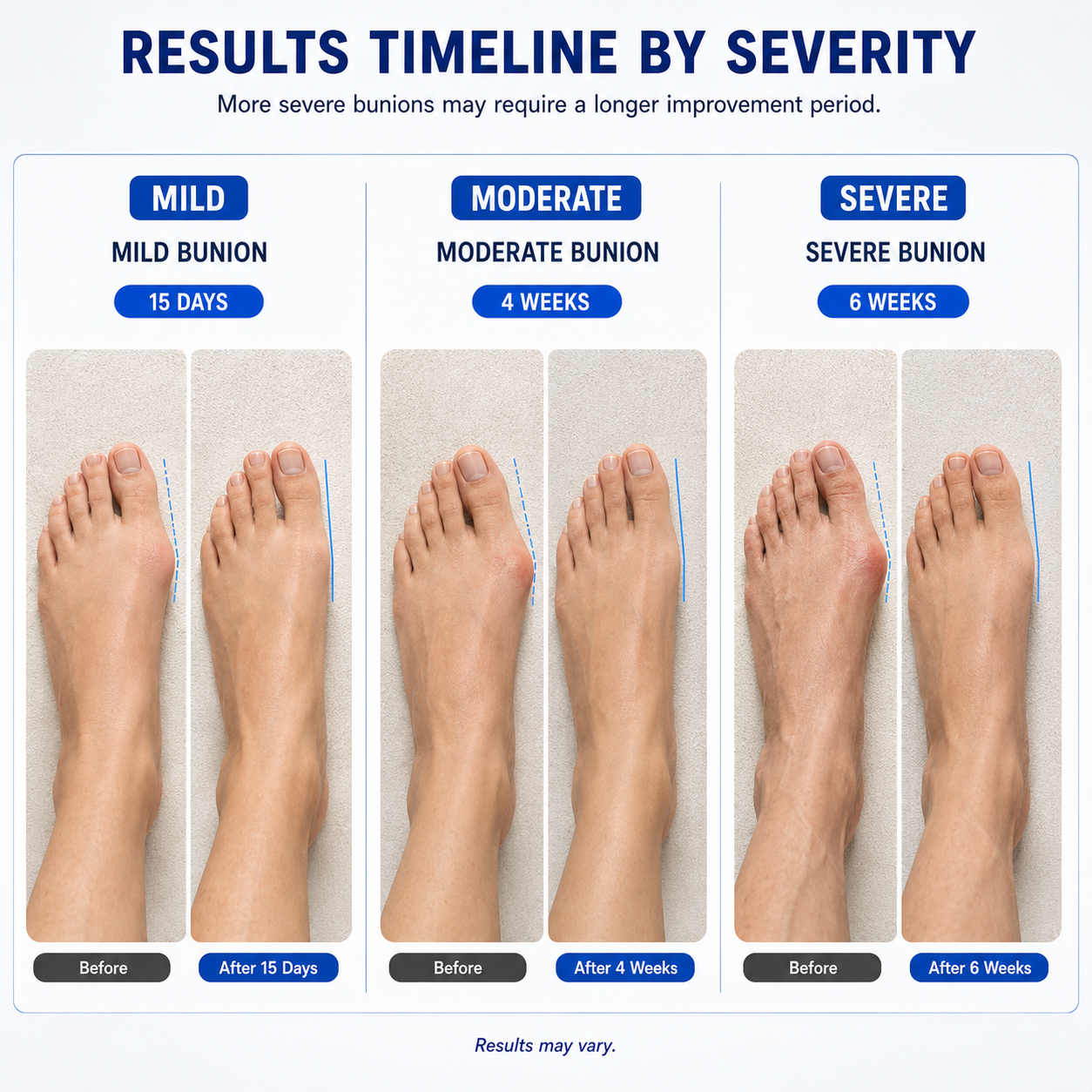 Aurora Tech™ — EMS Bunion Corrector